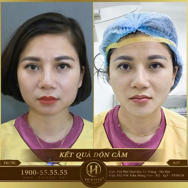 Phẫu thuật thẫm mỹ độn cằm