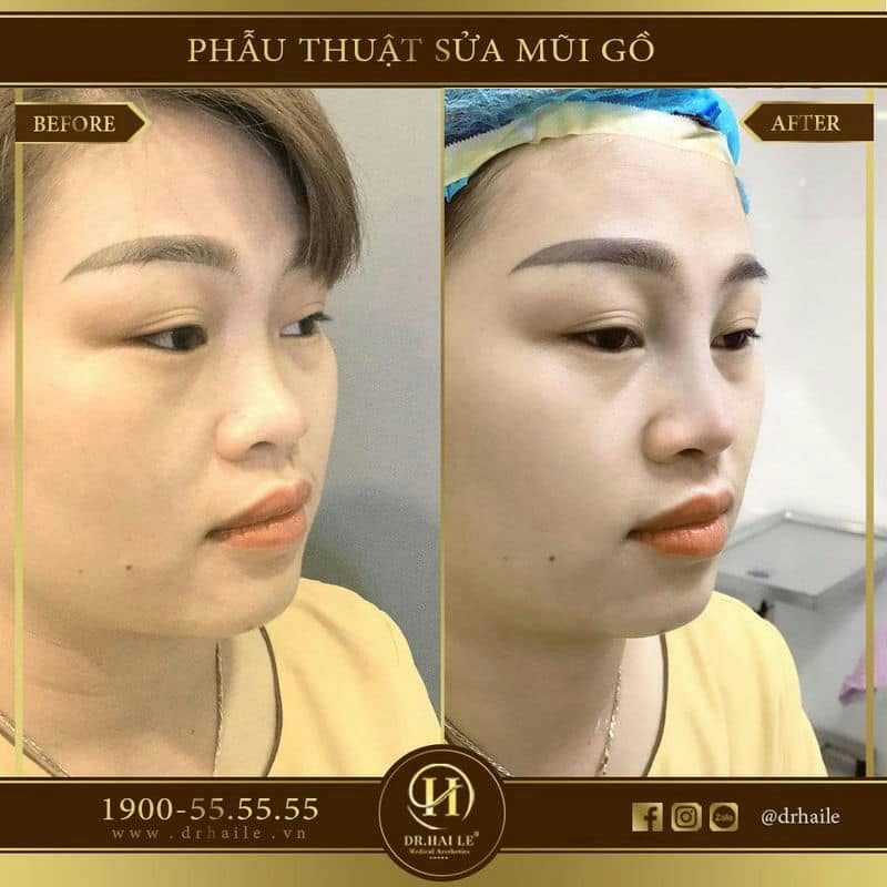 Phẫu thuật sửa mũi gồ