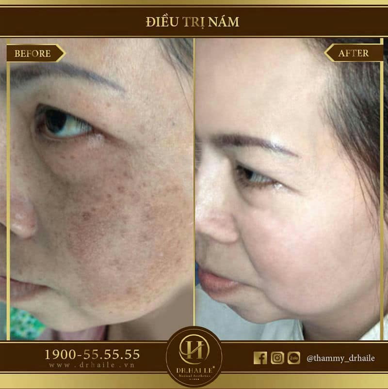 Công nghệ trị nám