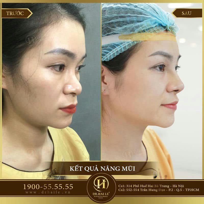 Nâng mũi Medi-Form