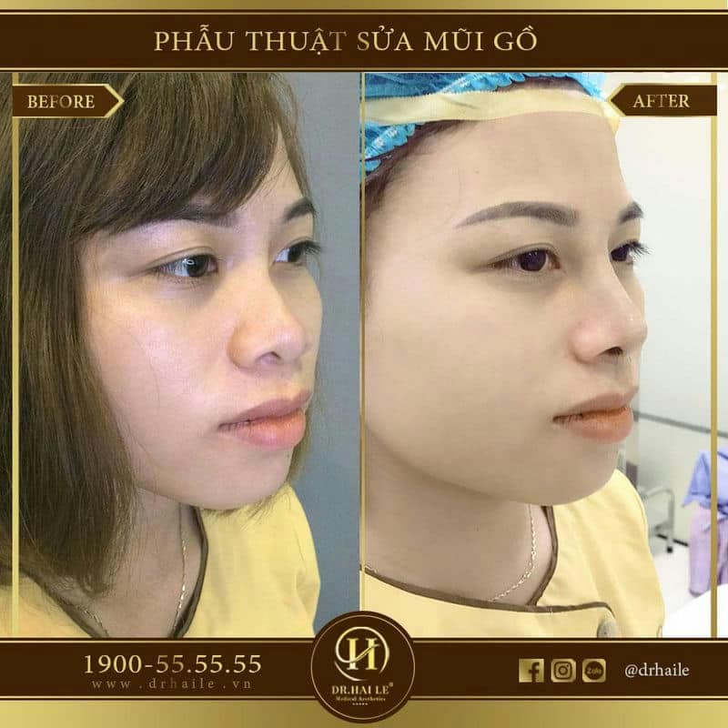 Phẫu thuật sửa mũi gồ