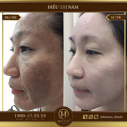 Công nghệ trị nám