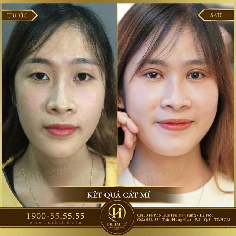 Cắt mí Double Deep 5D