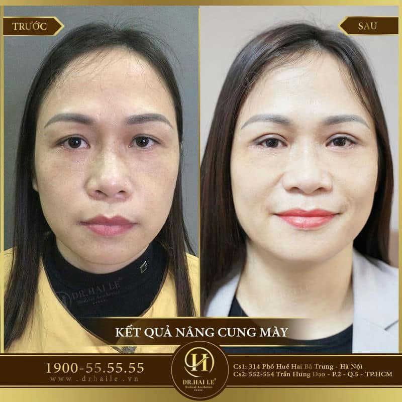 Nâng cung chân mày