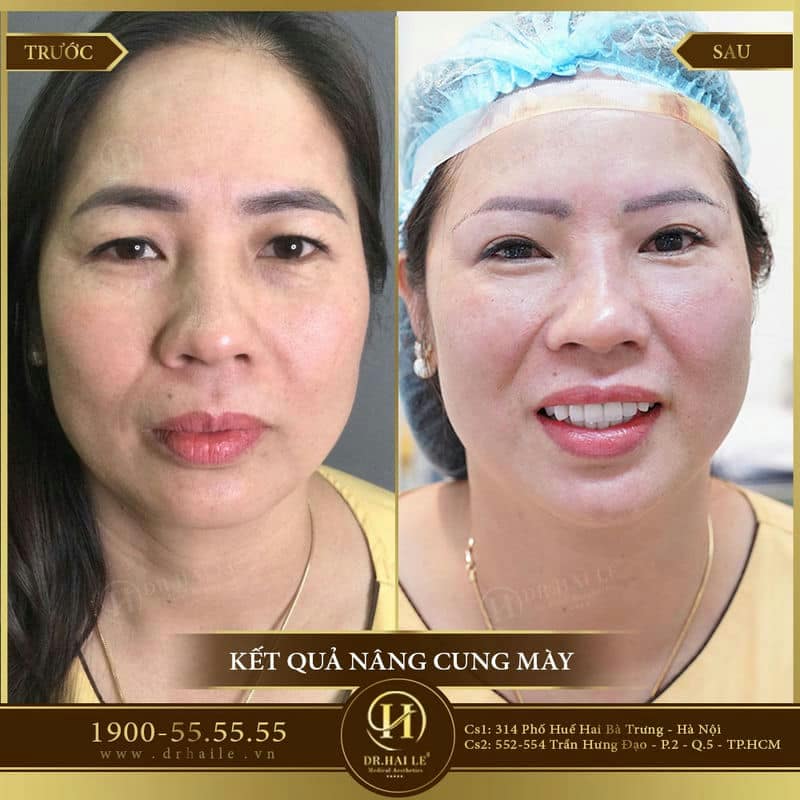 Nâng cung chân mày