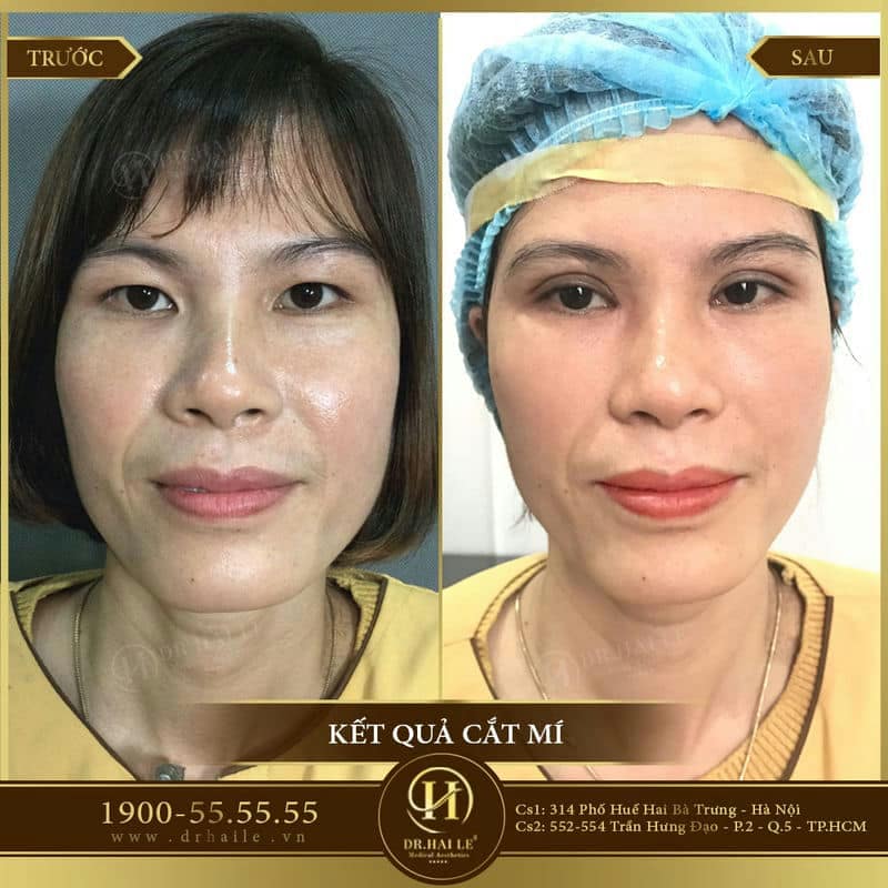 Cắt mí Double Deep 5D