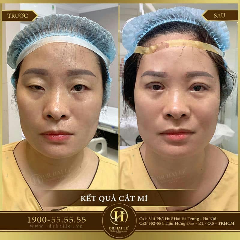 Cắt mí Mani Mini Deep 5D