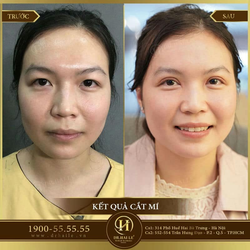 Cắt mí Mani Mini Deep 5D