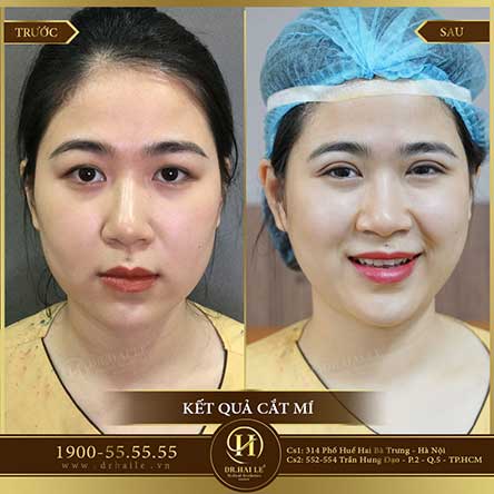 Cắt mí Mani Open Deep 5D