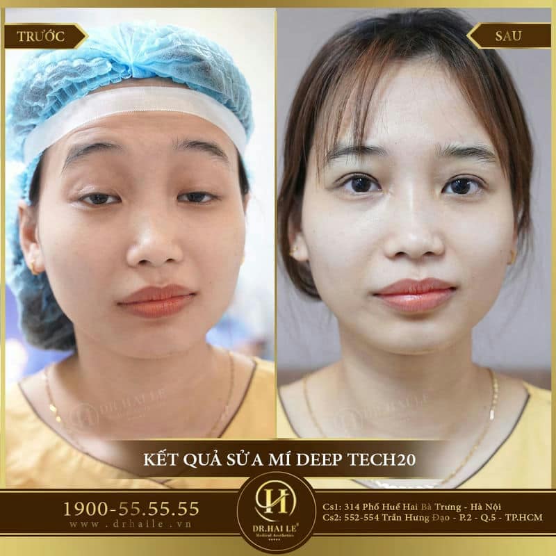 Sửa Mí Lỗi Hỏng Deep Tech20