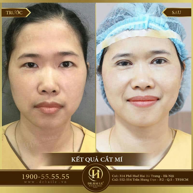 Cắt mí Double Deep 5D