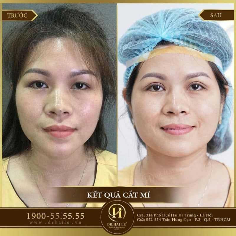 Cắt mí Double Deep 5D