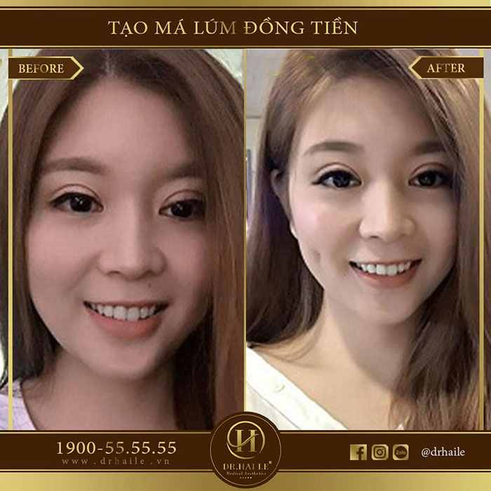 Tạo má lúm đồng tiền