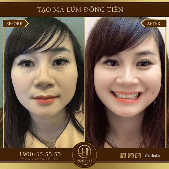 Tạo má lúm đồng tiền