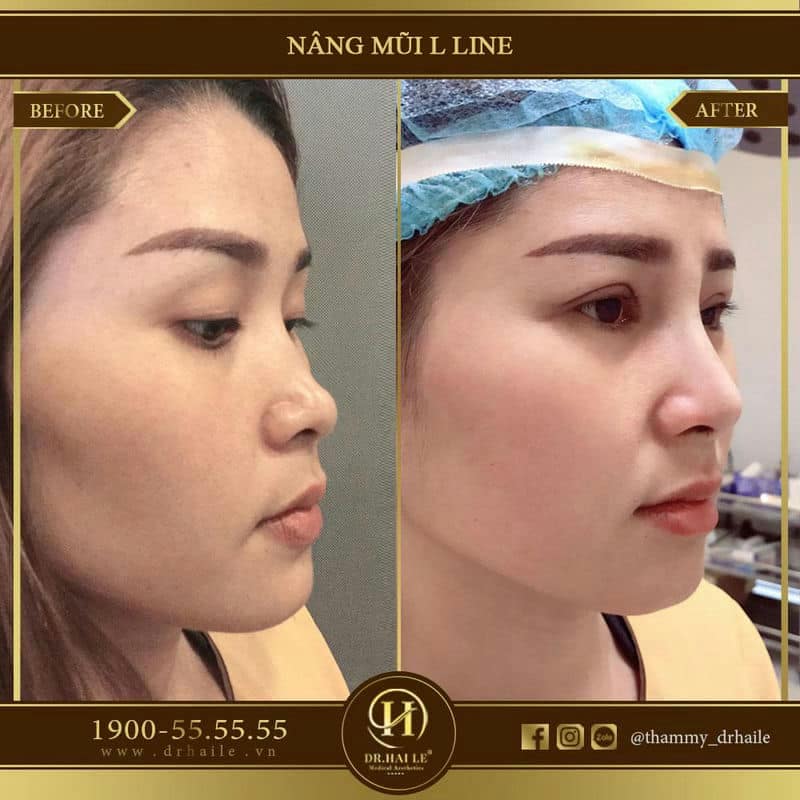Nâng mũi L Line