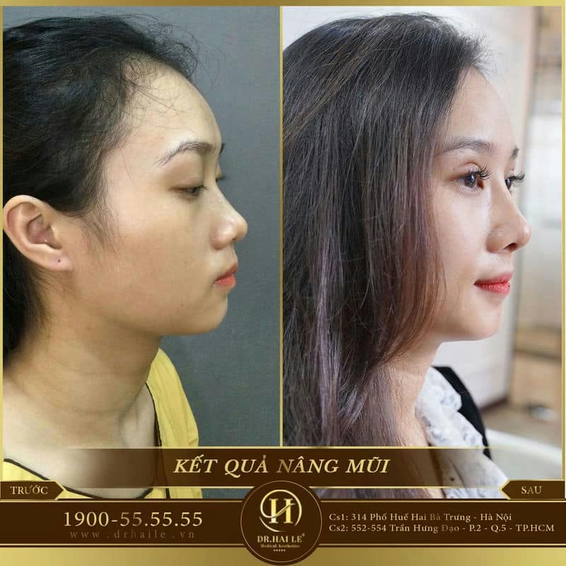 Nâng mũi L Line