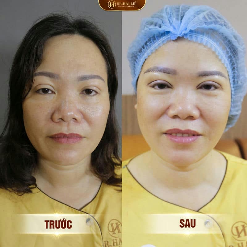 Ảnh trước sau  