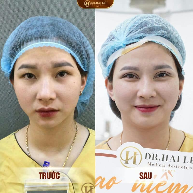 Ảnh trước sau  