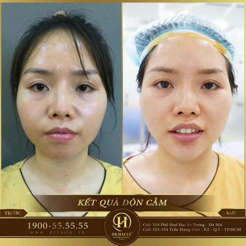 Phẫu thuật thẫm mỹ độn cằm