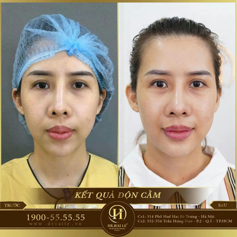 Phẫu thuật thẫm mỹ độn cằm