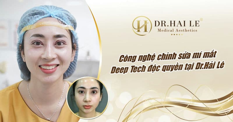 Công nghệ chỉnh mí mắt Deep Tech độc quyền tại Dr.Hải Lê
