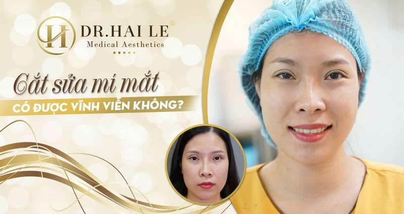 Cắt sửa mí mắt có được vĩnh viễn không?