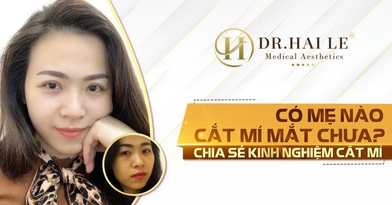 Có mẹ nào cắt mí mắt chưa? - Chia sẻ kinh nghiệm cắt mí
