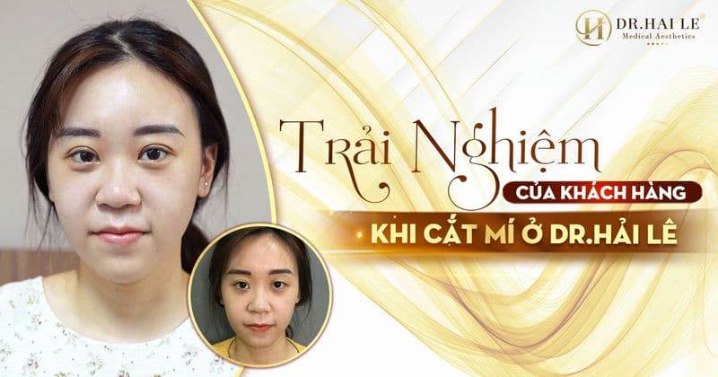 Trải nghiệm của khách hàng cắt mí ở Dr.Hải Lê