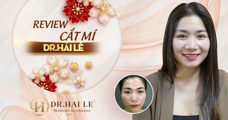 Review cắt mí - Dr.Hải Lê