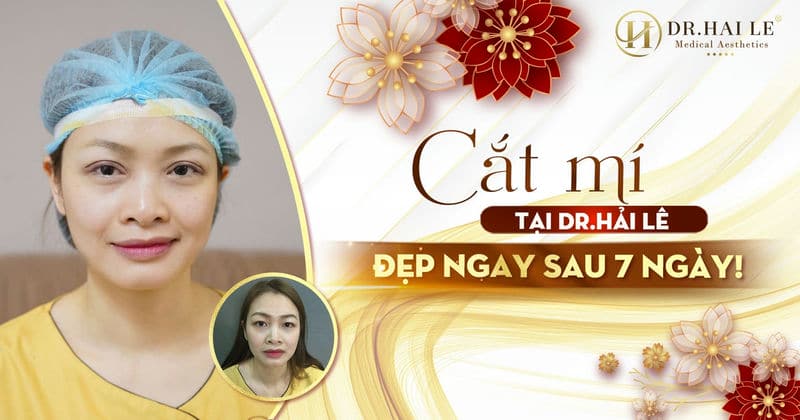 Cắt mí tại Dr.Hải Lê đẹp ngay sau 7 ngày!