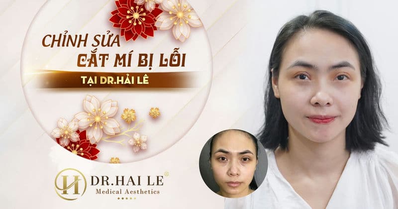 Chỉnh sửa cắt mí bị lỗi tại Dr.Hải Lê