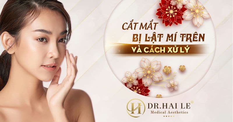 Cắt mắt bị lật mí trên và cách xử lý