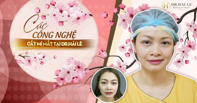 Các công nghệ cắt mí mắt Dr.Hải Lê