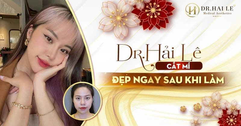 Dr.Hải Lê cắt mí - Đẹp ngay sau khi làm