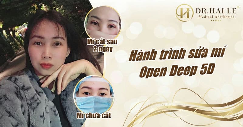 Hành trình thay đổi của khách hàng khi cắt mí mắt tại Dr.Hải Lê