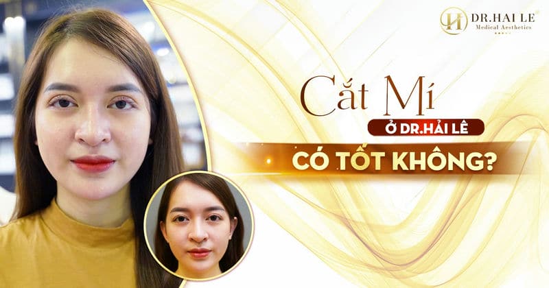 Cắt mí ở Dr.Hải Lê có tốt không?