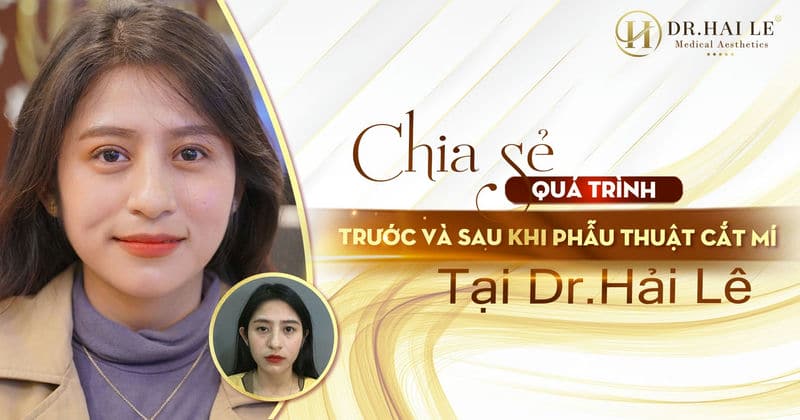 Chia sẻ quá trình trước và sau khi phẫu thuật cắt mí tại Dr.Hải Lê