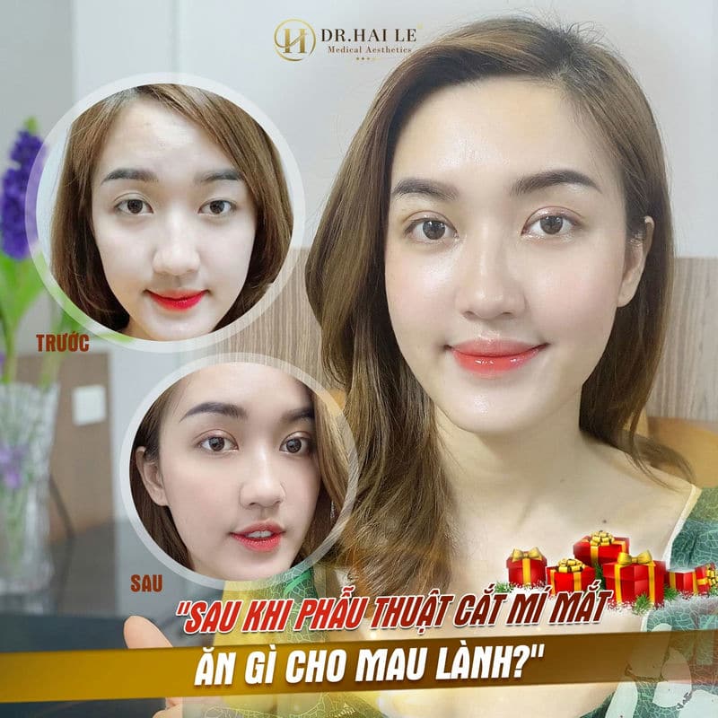 Sau khi phẫu thuật cắt mí mắt ăn gì cho mau lành?