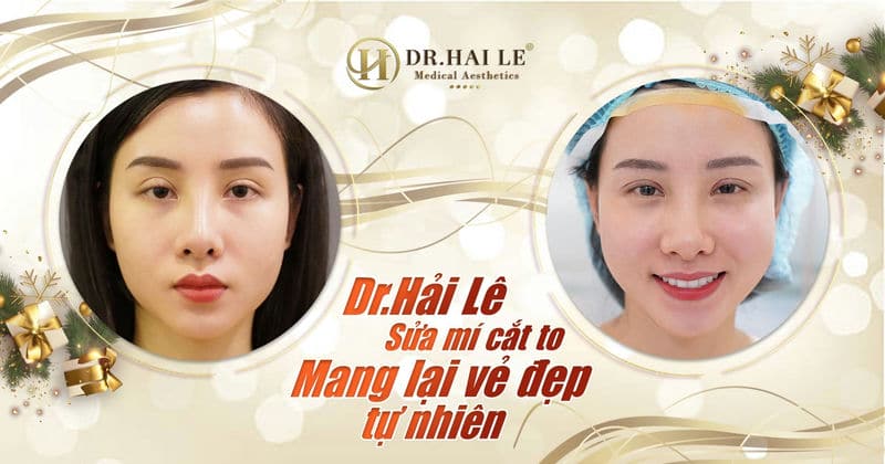 Dr.Hải Lê sửa mí cắt to mang lại vẻ đẹp tự nhiên