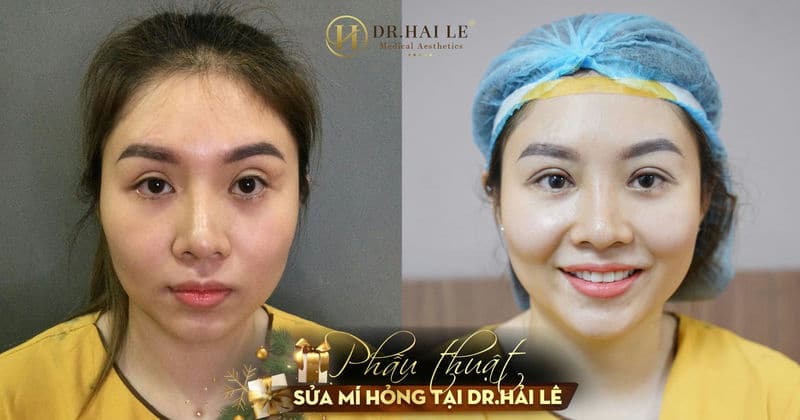 Phẫu thuật sửa mí hỏng tại Dr.Hải Lê