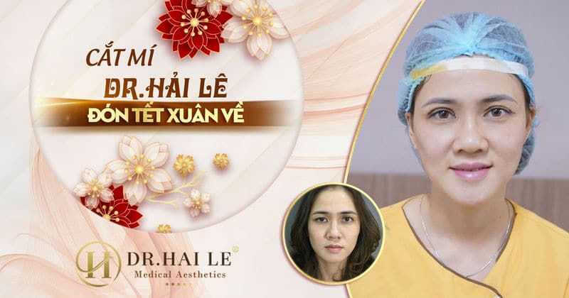 Cắt mí Hải Lê đón Tết đến xuân về