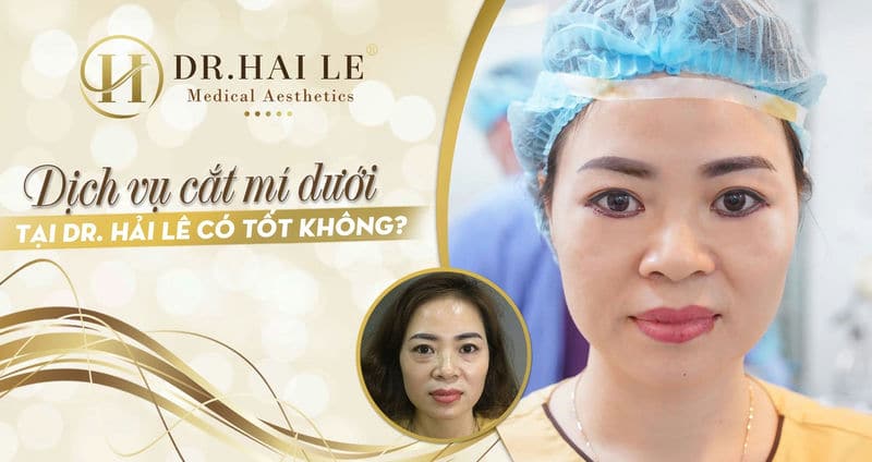 Dịch vụ cắt mí dưới tại Dr. Hải Lê có tốt không?
