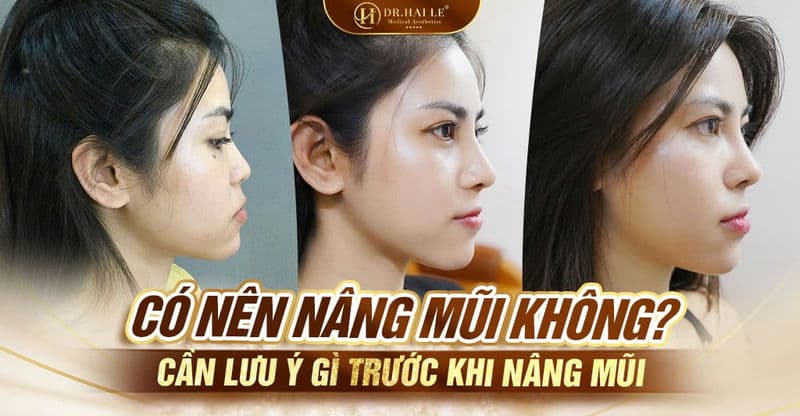 Có nên nâng mũi không? Cần lưu ý gì trước khi nâng mũi