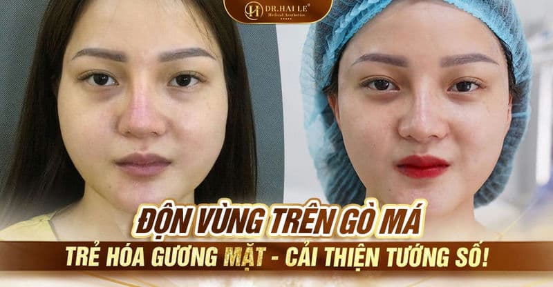 Độn vùng trên gò má - Trẻ hóa gương mặt - Cải thiện tướng số!