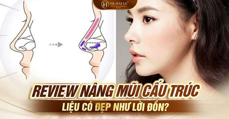 Review nâng mũi cấu trúc liệu có đẹp như lời đồn?