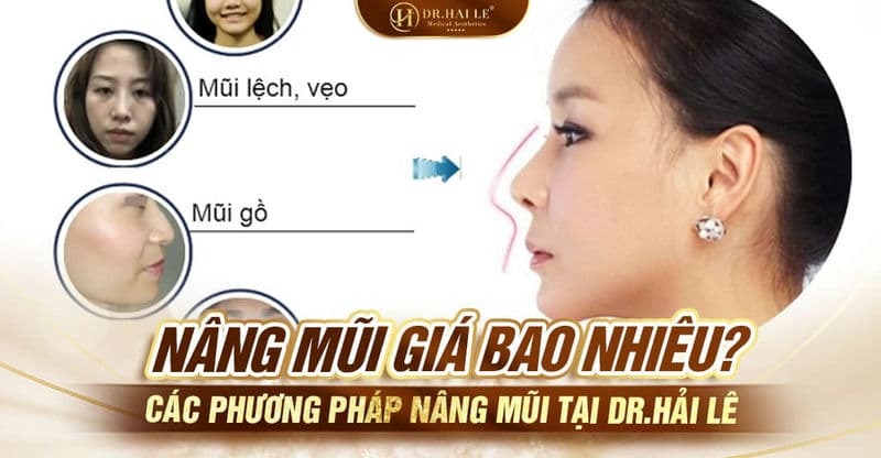 Nâng mũi giá bao nhiêu? Các phương pháp nâng mũi tại Dr.Hải Lê