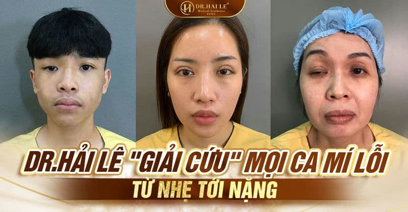 Dr.Hải Lê "giải cứu" mọi ca mí lỗi từ nhẹ tới nặng