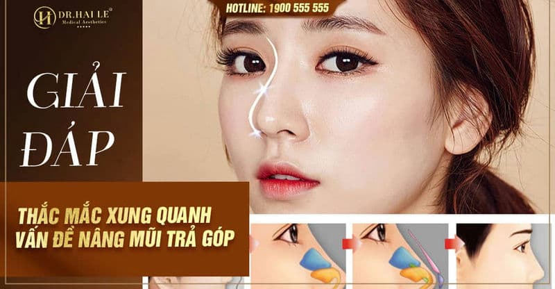 Giải đáp thắc mắc xung quanh vấn đề nâng mũi trả góp