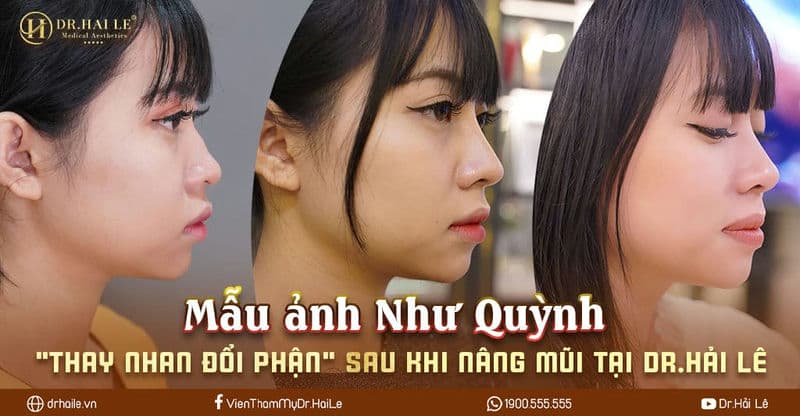 Mẫu ảnh Như Quỳnh "thay nhan đổi phận" sau khi nâng mũi tại Dr.Hải Lê Mẫu ảnh Như Quỳnh "thay nhan đổi phận" sau khi nâng mũi tại Dr.Hải Lê