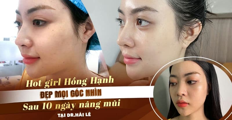 Hot girl Hồng Hạnh cùng hành trình tìm kiếm góc nghiêng "triệu like" tại Dr.Hải Lê Sài Gòn Hot girl Hồng Hạnh cùng hành trình tìm kiếm góc nghiêng "triệu like" tại Dr.Hải Lê Sài Gòn